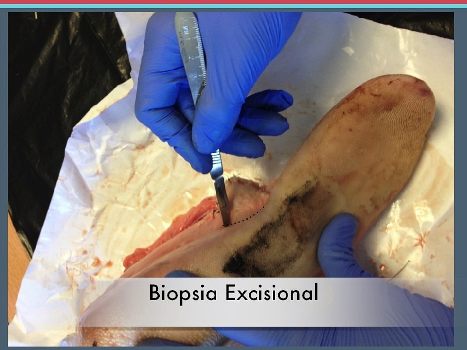 Biopsia PAAF, Excisional y Incisional