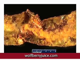 Diabetes diet Impact of wolfberry (goji) in NingXia Red