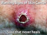 Screening for Skin Cancer (Skin Cancer #10)
