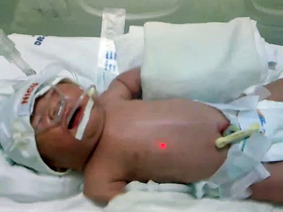 My baby- born at 36 weeks gestation. CS- mom with preeclampsia