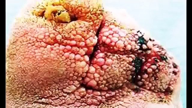 World's Worst Chin Zits, Acne, Cysts, Comedones and Blackheads