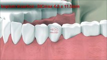 Dental Implantology - Guided Surgery Animation: SICace implant insertion