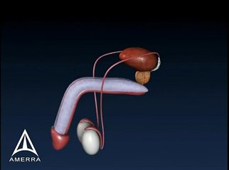 Enlarged Prostate - 3D Medical Animation