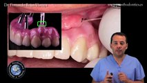 Higiene en prótesis fijas atornilladas - Dr. Fernando Rojas-Vizcaya (Spanish Version)