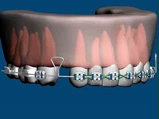 Effet de boucle en orthodontie