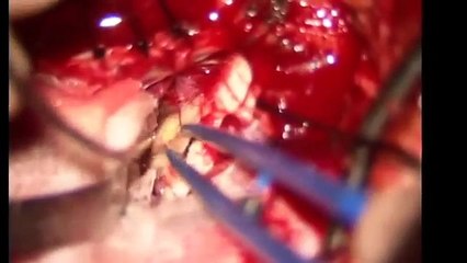 Microsurgical resection of a cavernoma located brain stem