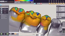 Prótese fixa - 2 elementos com braço retentor - Sistema CAD CAM - In Lab - Software - Zirkonzahn