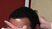 Dense Black Hair Transplant Hairline Restoration Result Bald Treatment Dr. Diep www.mhtaclinic.com