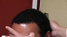 Dense Black Hair Transplant Hairline Restoration Result Bald Treatment Dr. Diep www.mhtaclinic.com