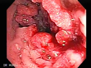 Rectal Cancer and Internal Hemorrhoids