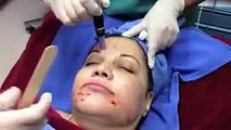 Dermapen PRP (Platelet Rich Plasma) Treatment Procedures