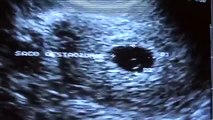 Vaginal Scan  - 5 weeks Pregnant