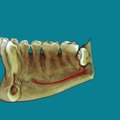Impacted Third Molars - 3D Cone Beam CT Scan and Animation by SmartScan Imaging of Orange