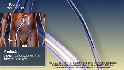 FIS - Varicocele Embolization