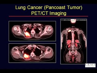 GRACEcast-015_Cancer-101_David Djang Interview on PET Scans