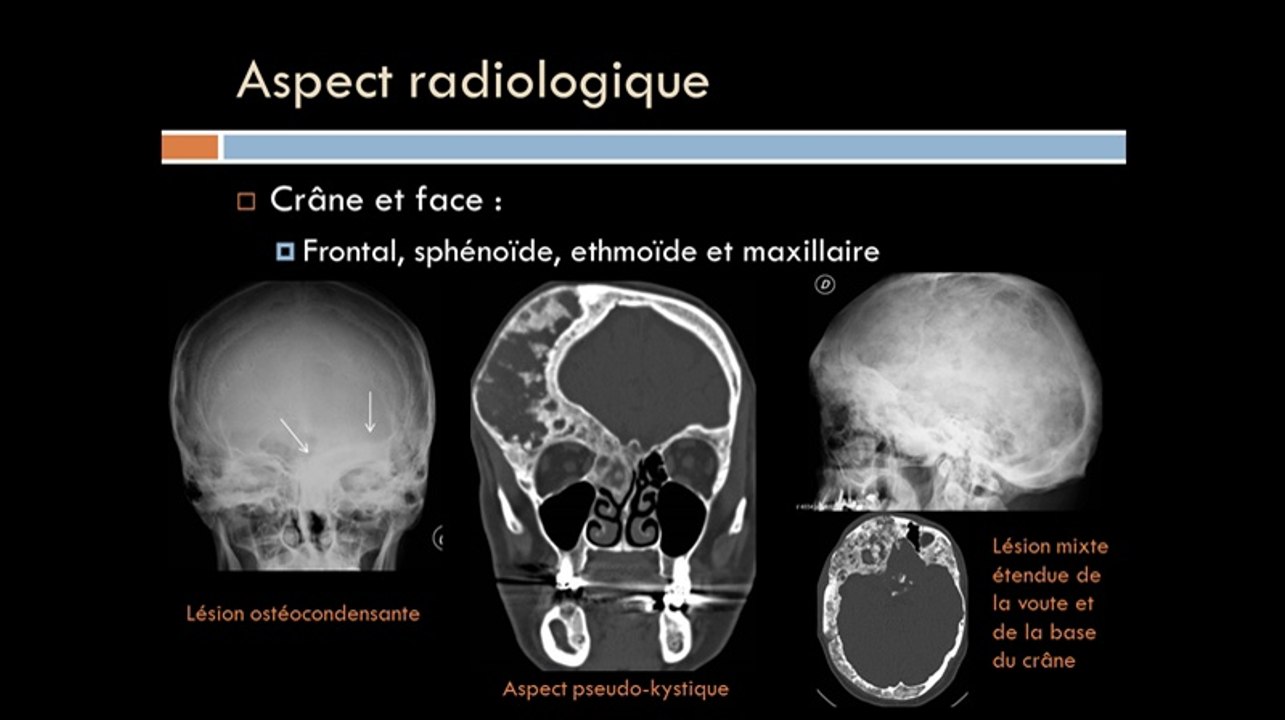 Dysplasie fibreuse