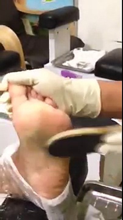 Removing corn in the foot TG in KL