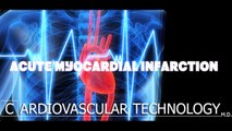 Acute Myocardial Infarction