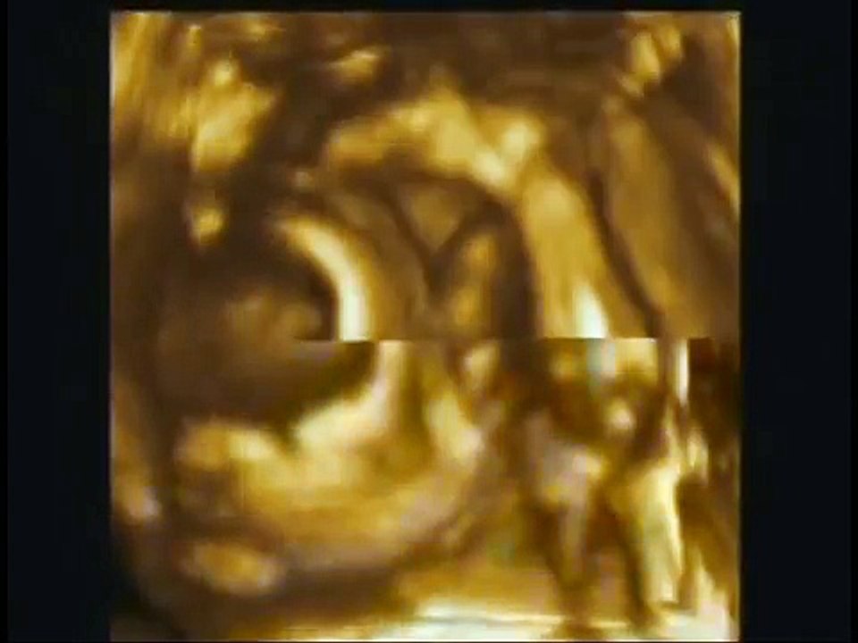 ECHOGRAPHIE 3D 24 semaines