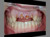 Dental composite restoration
