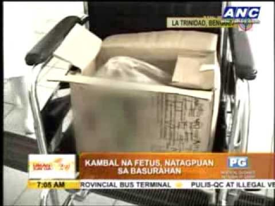 Twins aborted in Benguet