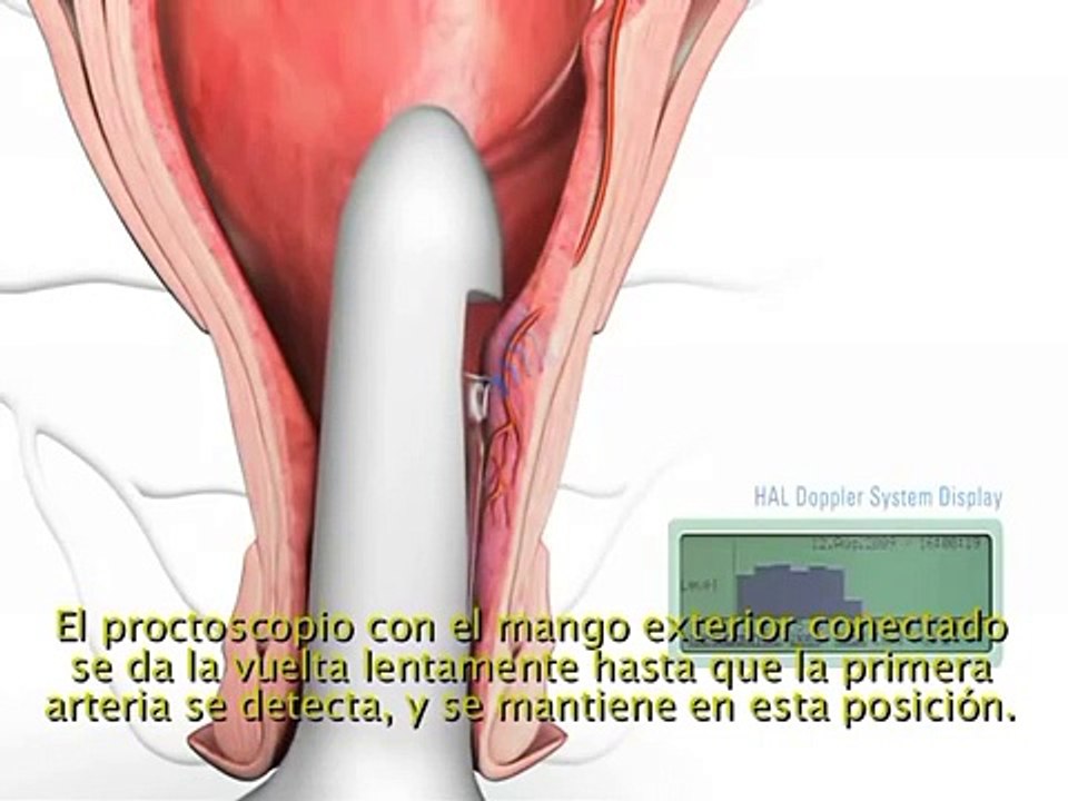 Tratamiento hemorroides internas DGHAL