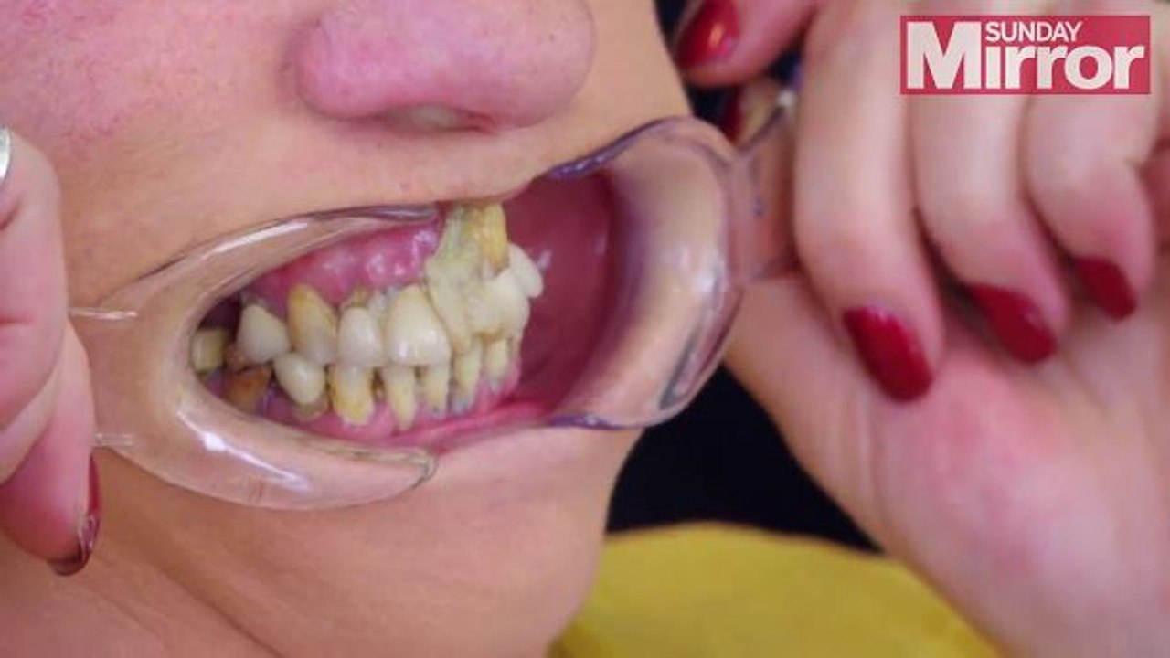 Une femme se colle les dents avec de la super glue