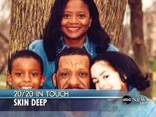 El Caso de Vitiligo de Desiree Simmons