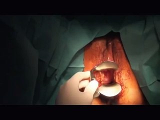 Système ablation de l'endomètre - démonstration
