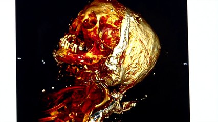 Fabuleuse découverte d'une momie de noble dame du XVIIème siècle à Rennes