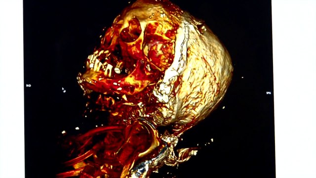 Fabuleuse découverte d'une momie de noble dame du XVIIème siècle à Rennes