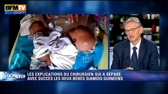 Jumeaux siamois séparés: Une petite incertitude chez l’un des bébés
