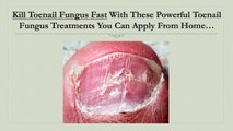 Kill Toenail Fungus Fast With This Powerful Toenail Fungus Treatment You Can Apply From Home