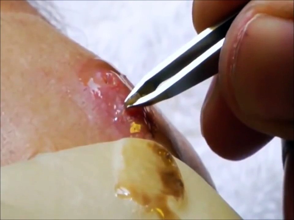 Botfly Removal