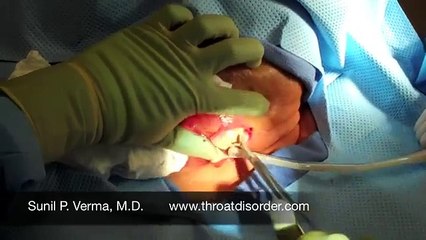 Neck abscess incision and drainage video - Dr. Sunil P. Verma M.D.