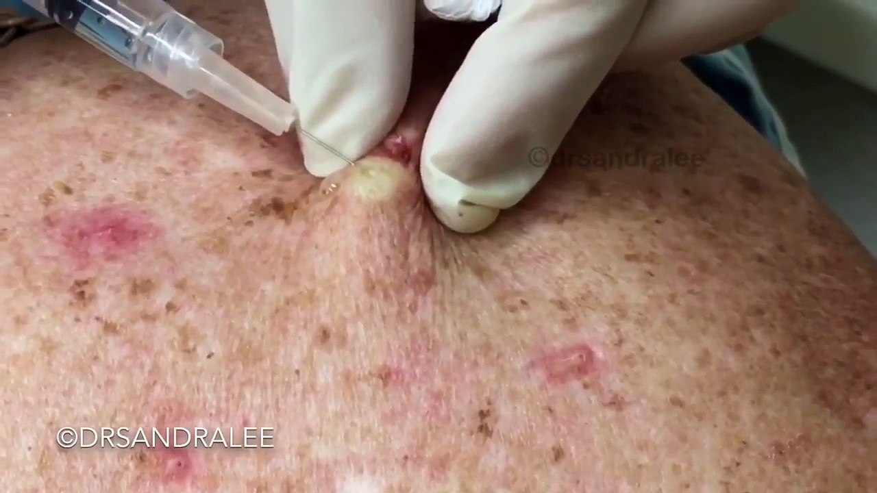 Punch excising an AWESOME cyst on the back! For medical education- NSFE.