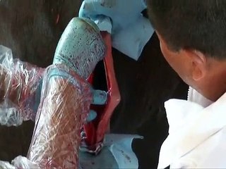Rumenotomía en bovinos 3.