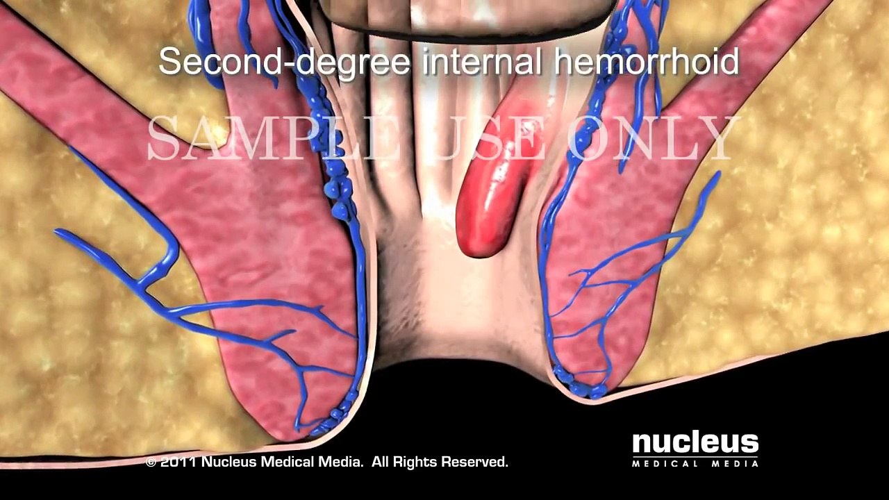 Hemorrhoidectomy (Hemorrhoid Surgery)