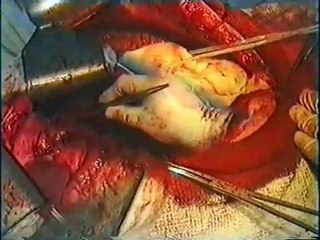 esophageal cancer surgery