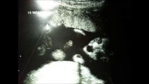 【ホラー】赤ちゃんのエコー写真に写った恐ろしいモノ