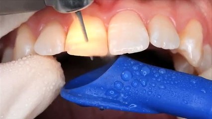 How to create an aesthetic ANTERIOR restoration using Filtek™ Supreme XTE