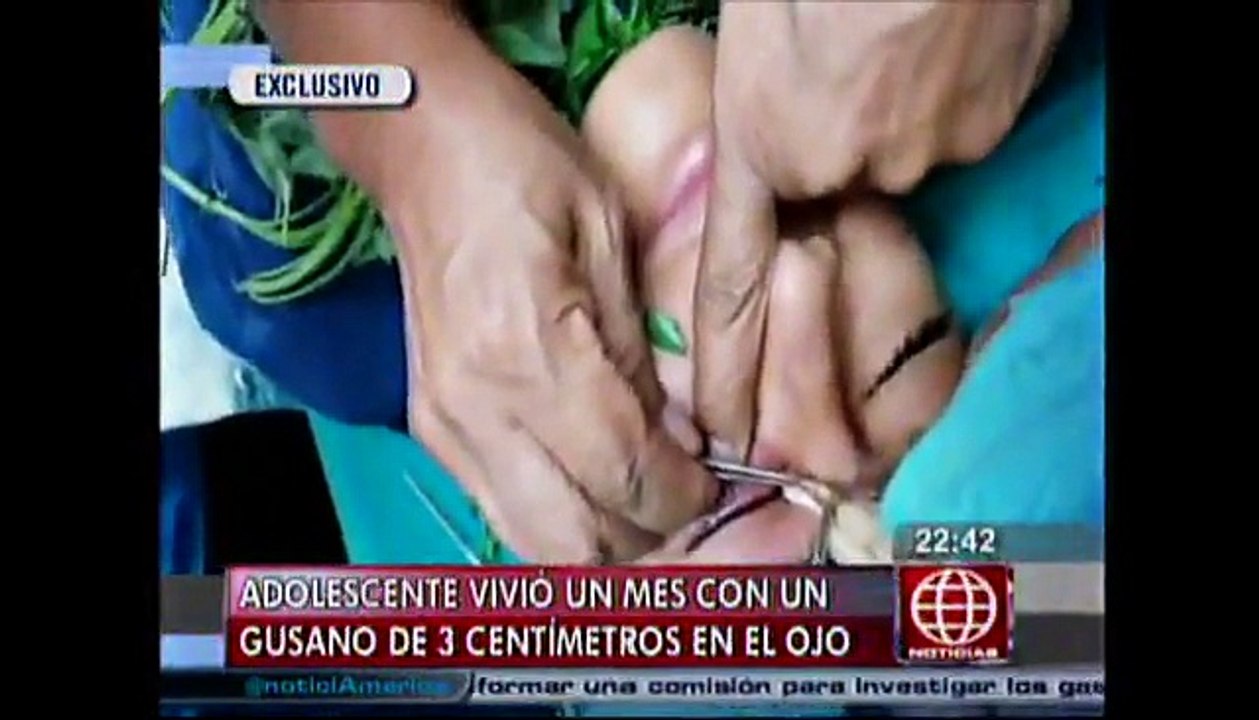 Lima: Adolescente estuvo un mes con un gusano de 3 cm. en el ojo
