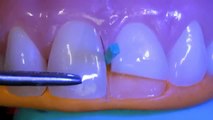 Caso Clínico. Técnicas para restauraciones clase IV y fracturas dentarias. - 3M ESPE