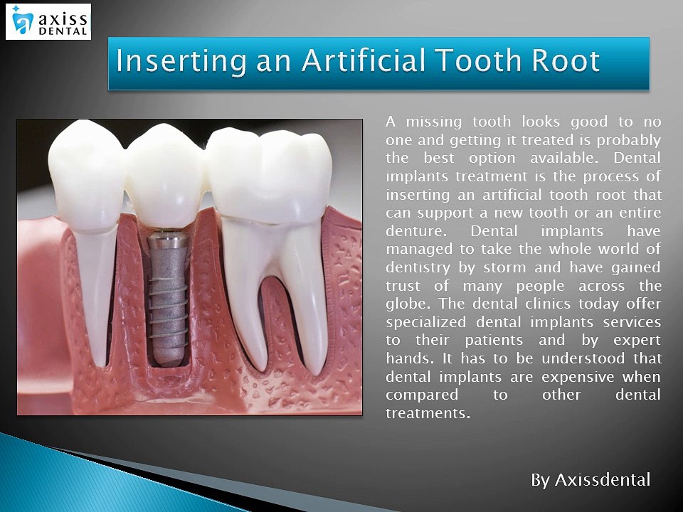 Dental Implants Treatment : Worth Considering or Not?