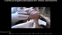 Lifting facial con hilos Distrito Federal 999-888-777 Clínica rejuvenecimiento facial con hilos