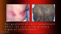 Diagnostic Challenges in Cutaneous T-Cell Lymphoma