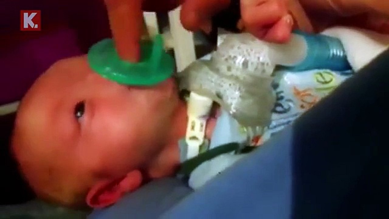 ABD'de burunsuz doğan bebek