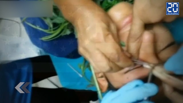 Il se retrouve avec un ver dans l'oeil. - Le Rewind du Vendredi 5 juin 2015