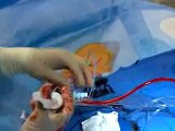 Live Webcast: Cardiac Catheterization, Angioplasty & Stent