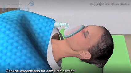 Rhinoplasty Nose Surgery Animation - Dr. Steve Merten in Sydney, Australia
